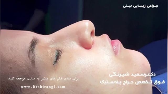 فیلم قبل و بعد از عمل زیبایی بینی دکتر سعید شیرنگی