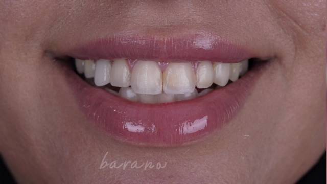تضمین طرح لبخند شما با کامپوزیت دندان در کلینیک بارانا