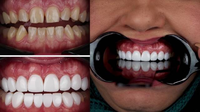 تکنیک بستن دیاستم (فاصله دندان‌ها) با کامپوزیت ونیر در دندانپزشکی عرشیان