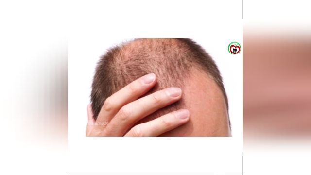 درمان ریزش مو در زنان و مردان.