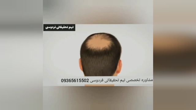 علت ریزش مو چیست؟؟ 