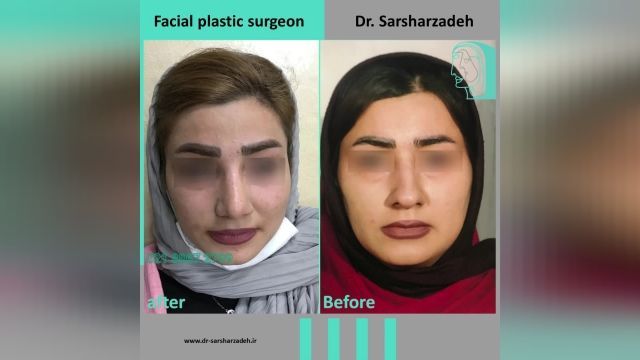  انجام جراحی بینی برای زیباجوی عزیز توسط دکتر پژمان سرشارزاده