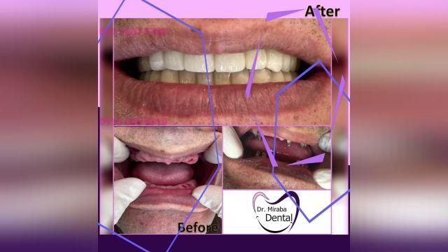 بازسازی کامل دندان های فک های بالا و پایین