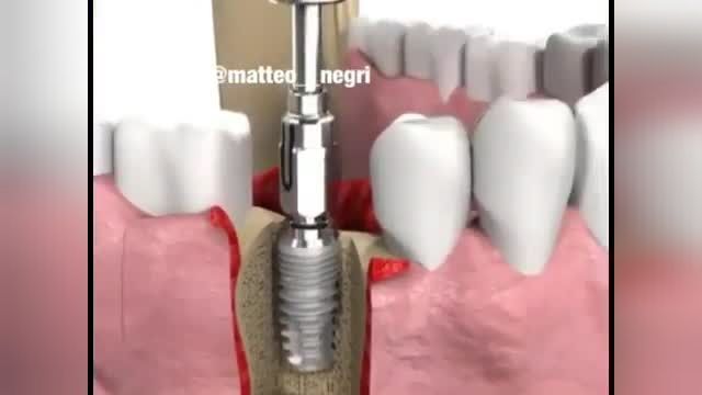 نحوه کاشت دندان