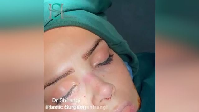 فیلم کامل جراحی بینی در کلینیک دکتر سعید شیرنگی