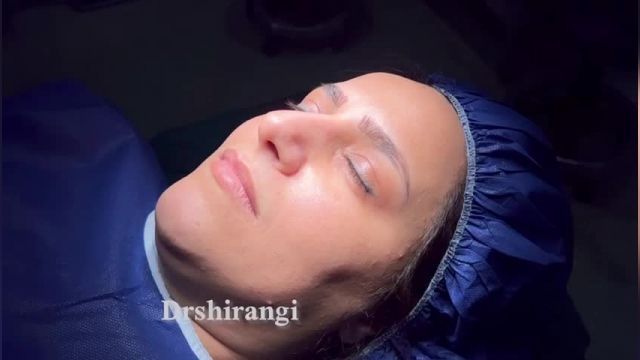 فیلم رینوپلاستی از نمای نزدیک در کلینیک دکتر سعید شیرنگی