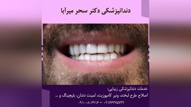  انجام ونیر کامپوزیت چهارده دندان برای زیباجوی عزیز