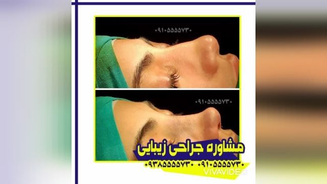 جراحی زیبایی بینی در کرمان