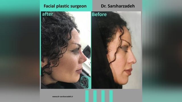  انجام جراحی بینی برای زیبا جوی عزیز توسط دکتر پژمان سرشارزاده