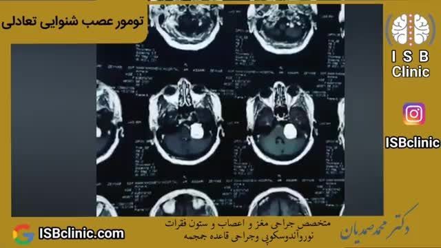 تومور عصب شنوایی تعادلی (نوروم آکوستیک یا تومور آکوستیک)