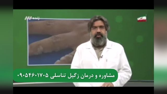 درمان قطعی زگیل تناسلی در شبکه تلویزیونی 