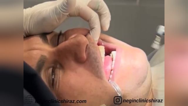 مراحل لمینت دندان در کلینیک دندانپزشکی نگین شیراز