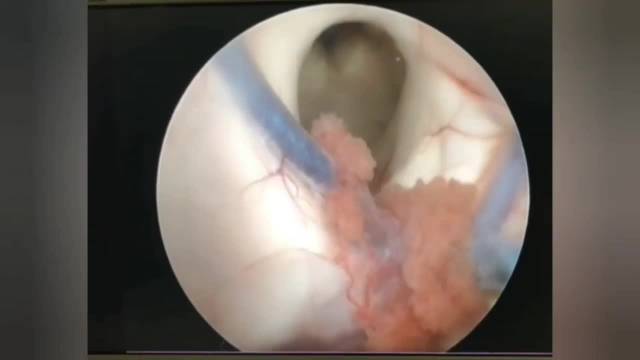 عمل جراحی ونتریکولوستومی آندوسکوپیک بطن سوم(ETV) جهت درمان هیدروسفالی 
