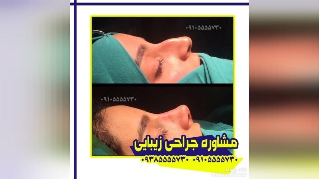 جراحی بینی استخوانی دربندر عباس