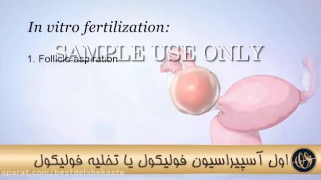 عمل IVF چیست؟؟؟