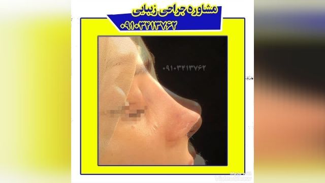 عمل جراحی زیبایی بینی در مشهد 