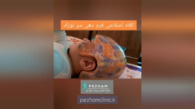 کلاه فرم دهی سر نوزاد - ساخت کلاه طبی برای اصلاح فرم سر نوزادان | کلینیک پژم