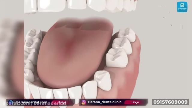 مراحل انجام بریج دندان 