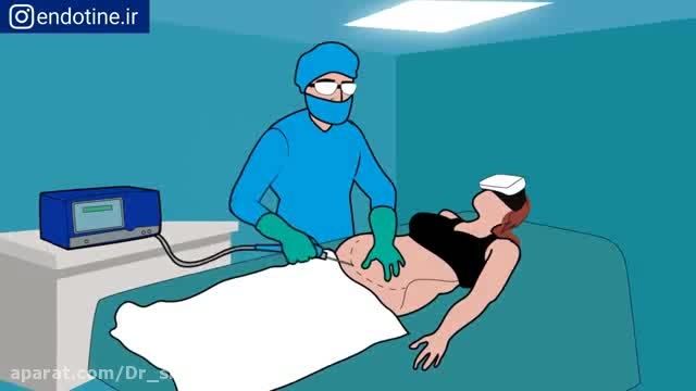 دکتر سعید شیرنگی | لیپوماتیک شکم و پهلو با دستگاه پال