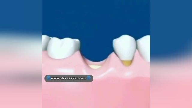 پودر استخوان برای ایمپلنت دندان