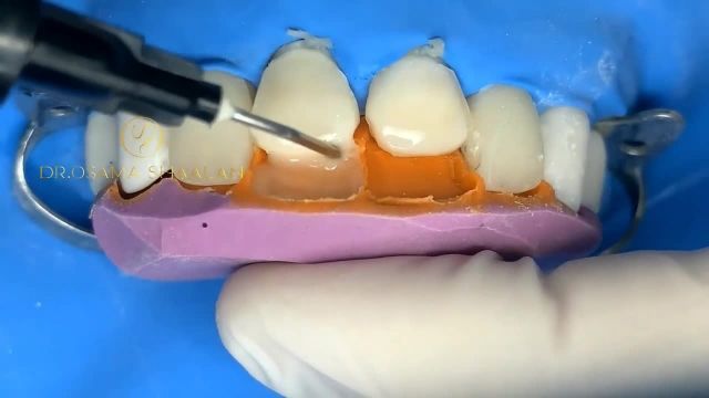 کامپوزیت دندان - مواد دندانپزشکی