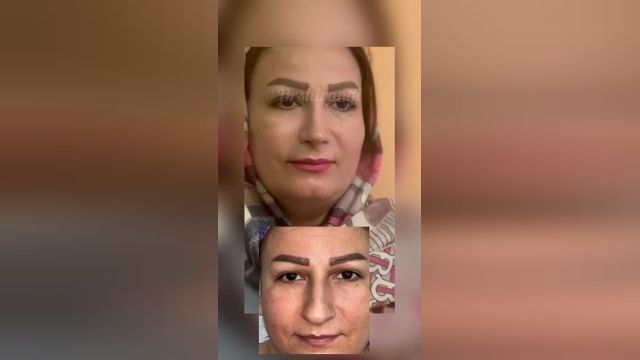 تجربه عمل بینی زیباجوی کلینیک دکتر سعید شیرنگی