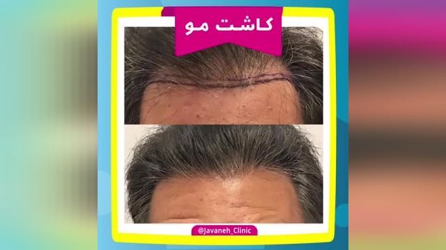 کاشت موی طبیعی به روشDHIبرای اولین بار در ایران بدون جراحی