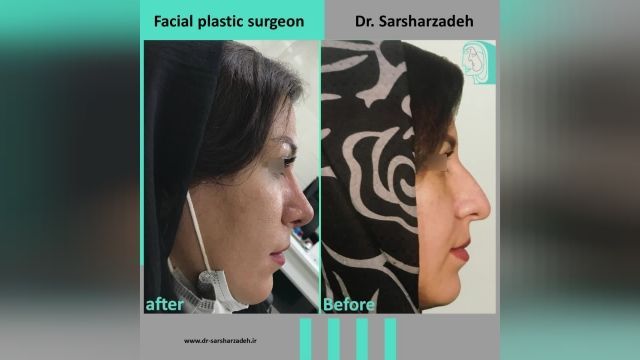 انجام جراحی زیبایی بینی برای زیباجو عزیز توسط دکترپژمان سرشا رزاده