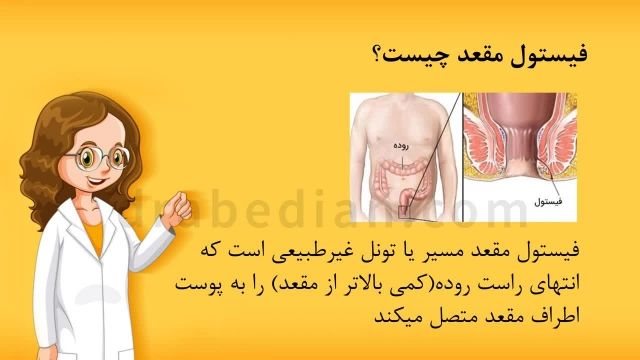 فیستول مقعدی چیست؟ علت ها و علائم / مرکز درمان تهران