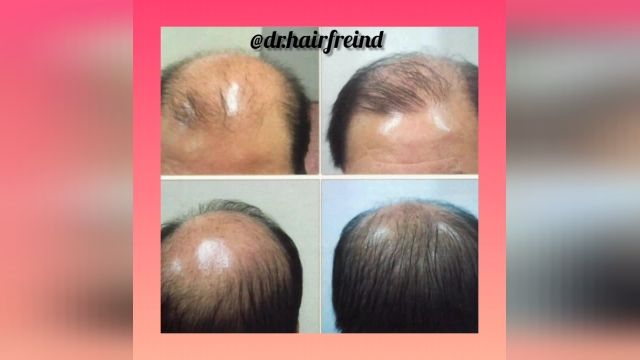 درمان ریزش مو و رویش مجدد مو بدون نیاز به کاشت 