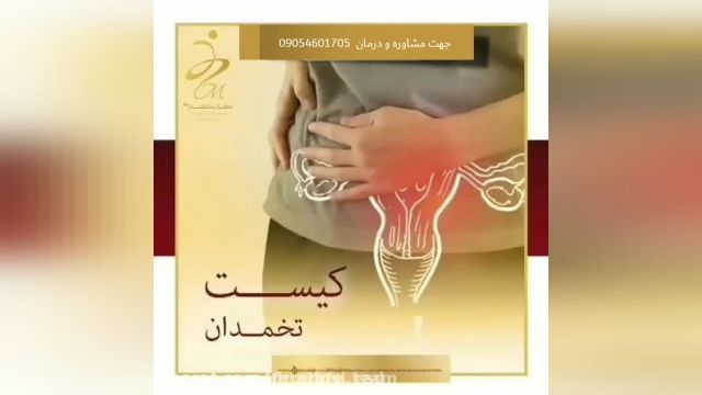 درمان کیست تخمدان و نازایی زنان