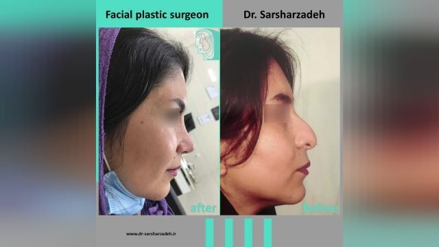  انجام عمل جراحی بینی برای زیباجوی عزیز توسط دکتر پژمان سرشارزاده