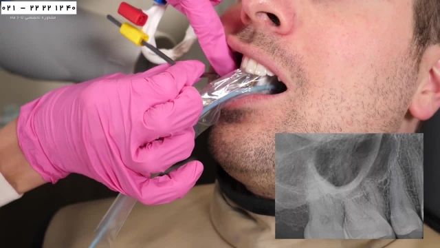 آموزش دستیار دندانپزشک - نحوه گرفتن عکس رادیولوژی دندان