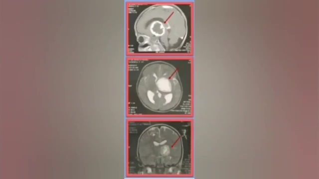 ✔️جراحی تومور مغز با استفاده از نورومانیتورینگ ومیکروسکوپ
