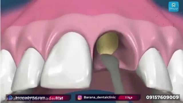 مراحل ایمپلنت دندان با پیوند استخوان