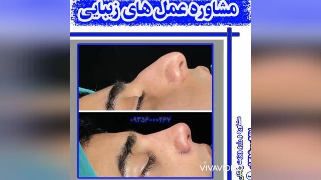 جراحی بینی گوشتی در همدان