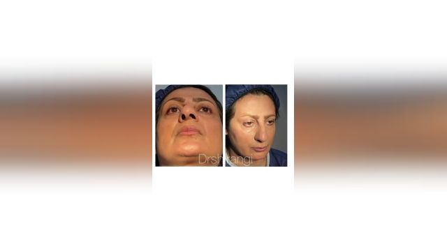فیلم واقعی جراحی زیبایی بینی بلافاصله پس از عمل زیبایی بینی توسط دکتر شیرنگی