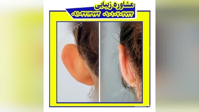 نمونه کار قبل و بعد جراحی زیبایی گوش گرگان