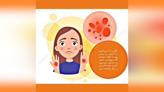 اگزما درمان حتمی دارد????????????
