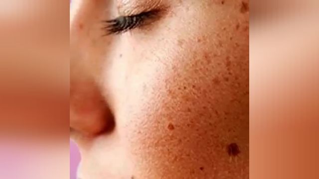 درمان قطعی لک های پوستی با کمترین هزینه 