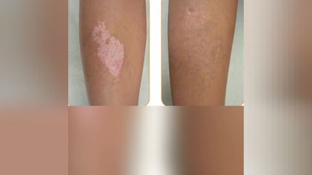 بهبود و درمان بیماری پوستی پیسی و ویتیلیگو