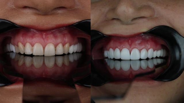 اصلاح طرح لبخند با ونیر کامپوزیت - دندانپزشکی عرشیان