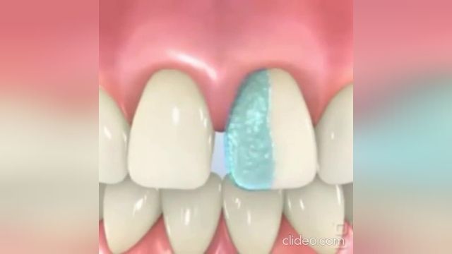 بستن فاصله دندانها