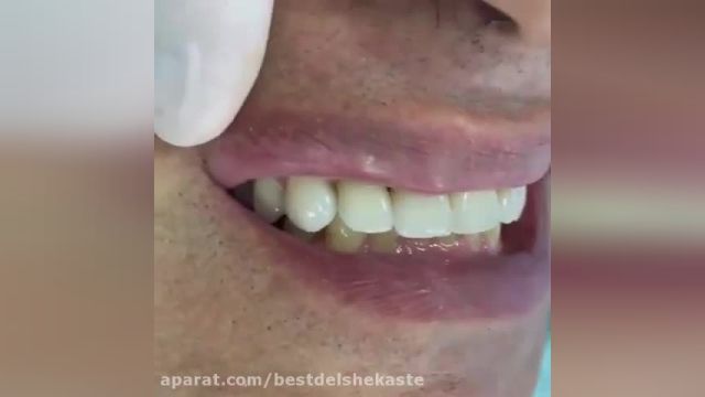 دانلود ویدیو ای از ایمپلنت دندان زیبا