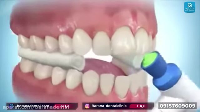 انجام مراحله ارتودنسی دندان