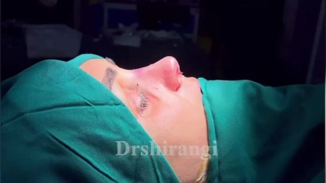 نمونه واقعی جراحی بینی توسط دکتر سعید شیرنگی