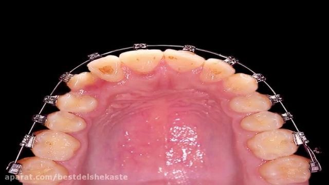 دانلود ویدیو ای درباره ی ارتودنسی بدون کشیدن دندان با سیستم دیمون