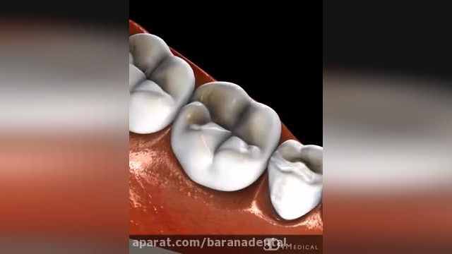 مراحل پر کردن دندان با آمالگام | پر کردن دندان با آمالگام خطرناک است؟