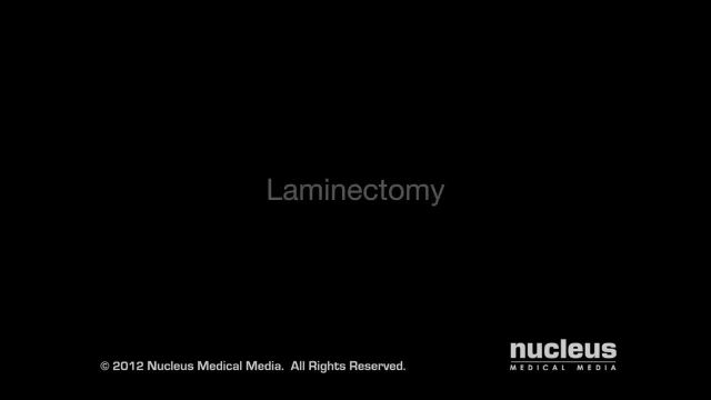 کمردرد: جراحی لامینکتومی کمر | ویدیو