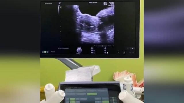 ویدیو انجام IVF که جالب است ببینید!
